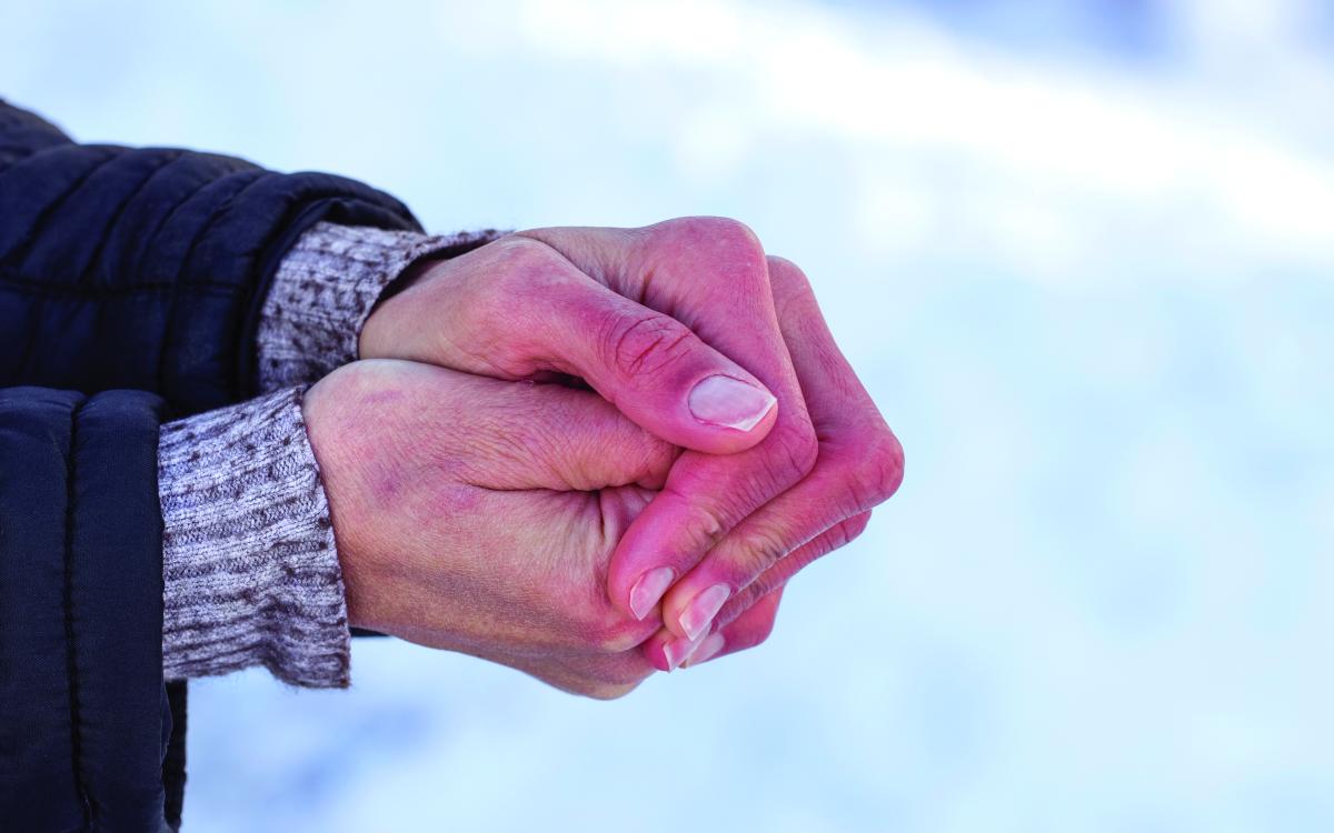 Frostbitten hands