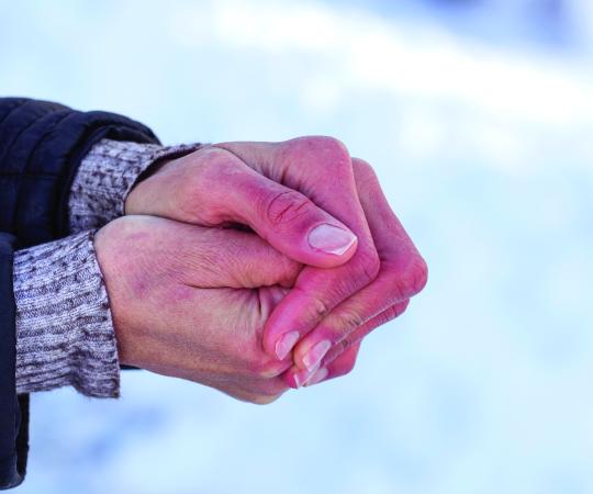 Frostbitten hands